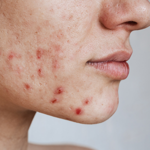 Acne