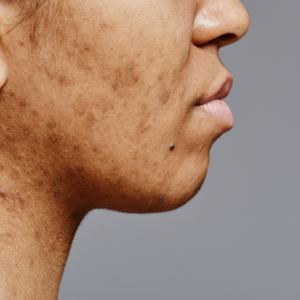 Pigmentation